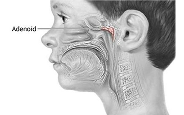 Adenoidektomi ( Geniz Eti Ameliyatı)