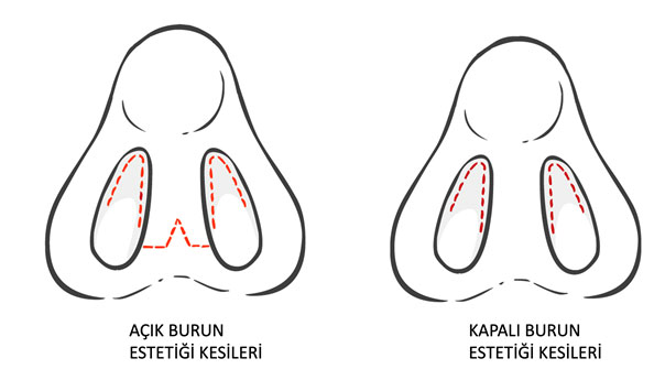 Açık Rinoplasti ile Kapalı Rinoplastinin farkı nedir?