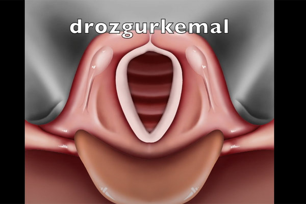 Vokal kord paralizileri ve tedavisi - Ses teli felci ve tedavisi